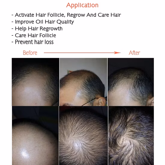276 Diode Laser Hair Care Cap Lllt Medical Laser Helmet 272 Diodes Cap for Hair Growth with CE