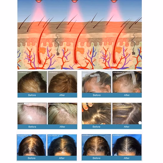 Laser Hair Growth Helmet LED Hair Regrowth Cap for Hair Loss Treatment