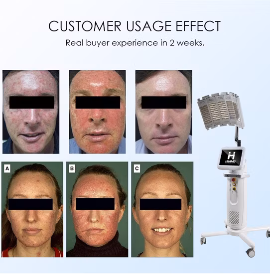 PDT Therapy Machine Photodynamic Therapy Medical Aesthetic Machine in High Efficiency