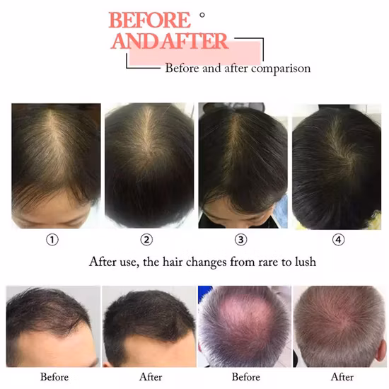 Professional Anti Hair Loss Treatment Diode Laser Hair Regrowth Machine